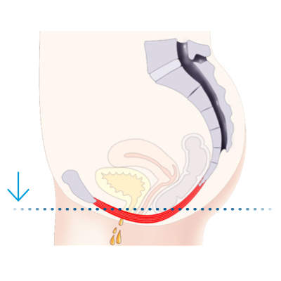 erectile dysfunction